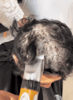 Picazón cuero cabelludo